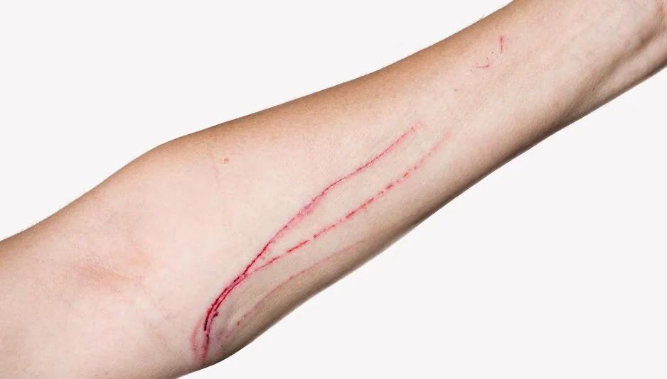 Bị mèo cào chảy máu có cần tiêm phòng không?