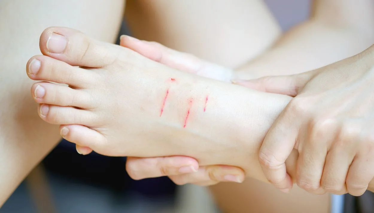 Mèo cào chảy máu có sao không? Có cần tiêm phòng không?